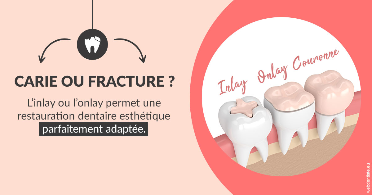 https://dr-bendahan-gabriel.chirurgiens-dentistes.fr/T2 2023 - Carie ou fracture 2