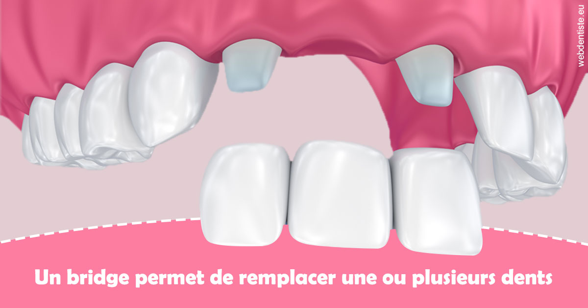 https://dr-bendahan-gabriel.chirurgiens-dentistes.fr/Bridge remplacer dents 2