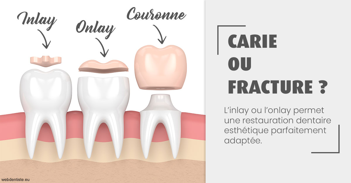 https://dr-bendahan-gabriel.chirurgiens-dentistes.fr/T2 2023 - Carie ou fracture 1