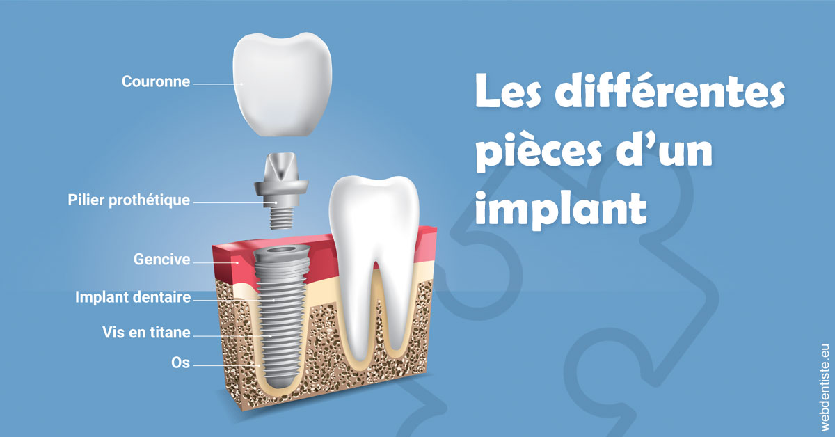 https://dr-bendahan-gabriel.chirurgiens-dentistes.fr/Les différentes pièces d’un implant 1